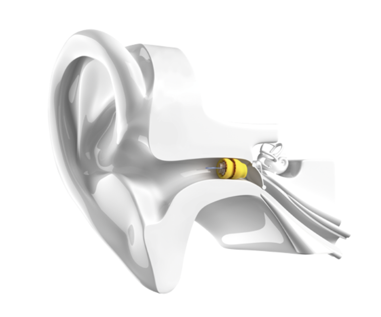 Should I Choose An Invisible Hearing Aid?